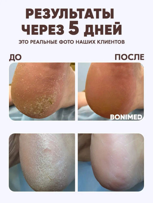 Крем от сухости и трещин на ступнях Bonimed, 125 мл Boni-0102