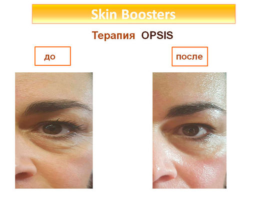 ОПСИС набор для омоложения области вокруг глаз (альтернатива блефаропластике) 2 предмета - Juliette armand фото 2