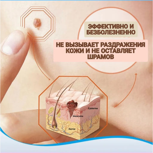 Крем для удаления бородавок, родинок и папиллом, 20 г