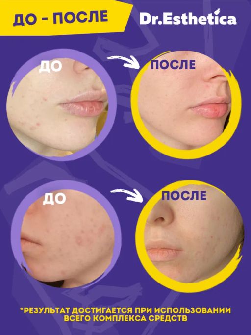 NO ACNE TEENS Крем-актив, 50 мл dr. esthetica  фото 6