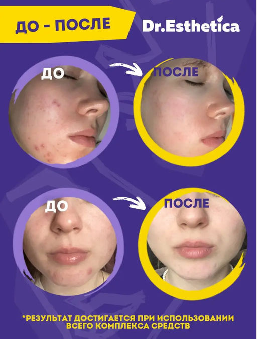 Пузырьковая мульти-маска PINK&GREEN 6+6 г DR. ESTHETICA NO ACNE TEENS  фото 8