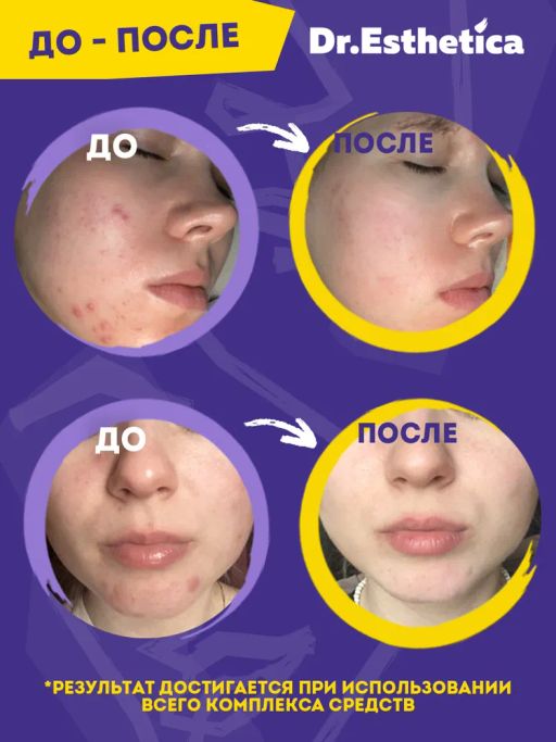Очищающая пенка-актив, 200 мл dr. esthetica NO ACNE TEENS  фото 6