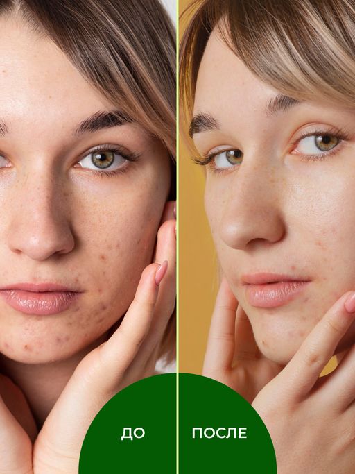 Комплекс гидролатов От чёрных точек и расширенных пор - Siberina фото 6