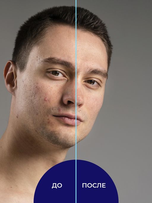 Тоник для лица и спины против прыщей, угрей и чёрных точек с цинком - Siberina фото 7