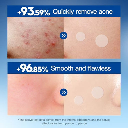 Мужские гидроколлоидные пластыри от прыщей и акне, 36 шт - Sadoer фото 3