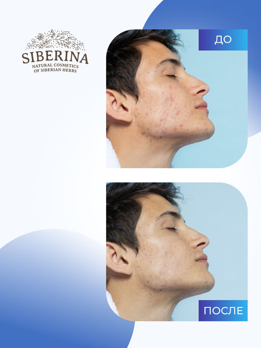 Тоник для лица и спины против прыщей, угрей и чёрных точек с цинком - Siberina фото 5