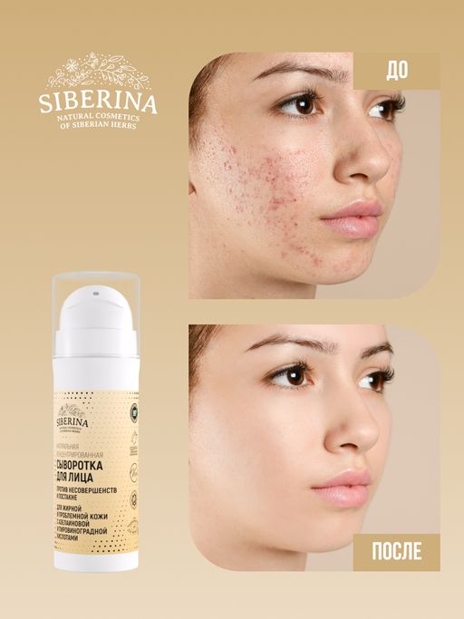 Концентрированная сыворотка для лица против несовершенств и постакне для жирной и проблемной кожи с азелаиновой и пировиноградной кислотами - Siberina фото 7