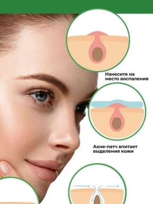 Патчи от прыщей, от акне  -24 шт