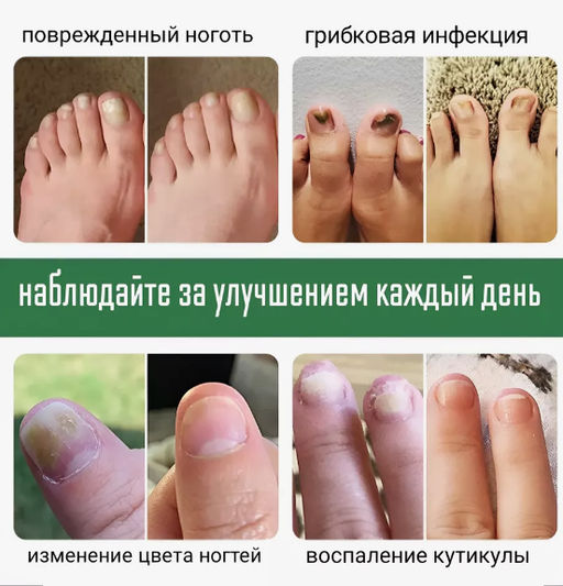 Крем для лечения грибка ногтей 30гр - Buro фото 2