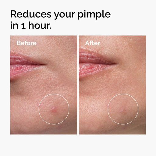 Sulfur 10% Powder-to-Cream Concentrate Концентрат серы 10% для точечного лечения акне