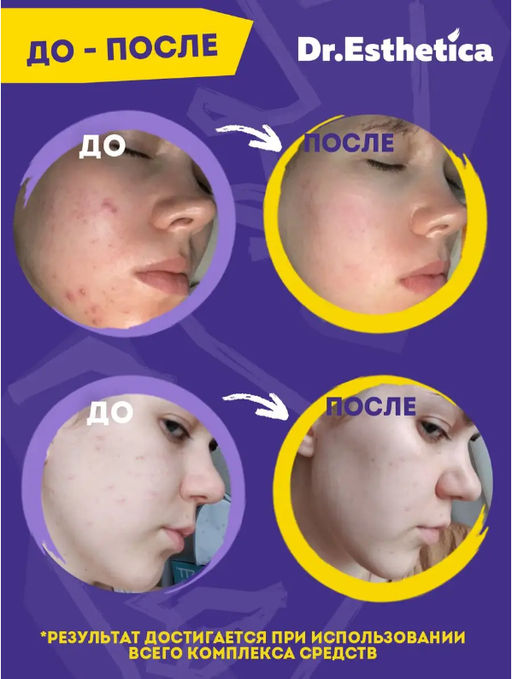 DR. ESTHETICA NO ACNE TEENS Пузырьковая мульти-маска YELLOW&VIOLET, 6+6 г 3 шт  фото 9