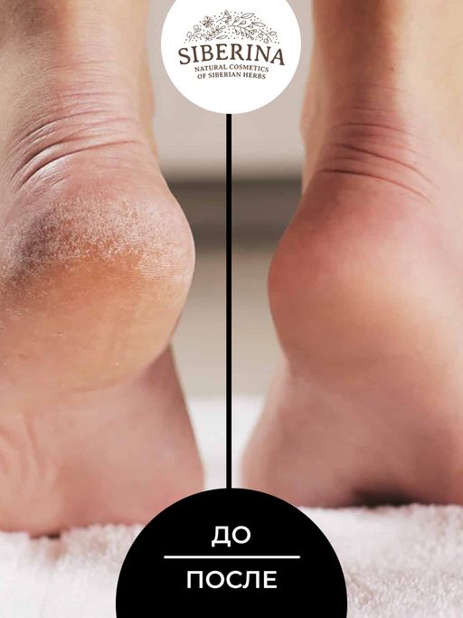Кератокрем для удаления огрубевшей кожи, мозолей и натоптышей с салициловой кислотой - Siberina фото 7